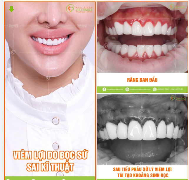 RĂNG SỨ - sai chỉ định , sai kỹ thuật HẬU QUẢ - viêm lợi và nguy cơ gây tiêu xương