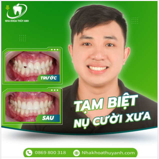 RĂNG SỨ THẨM MỸ TẠM BIỆT RĂNG SỨT MẺ