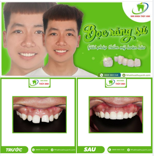 RĂNG SỨ THẨM MỸ- HẾT THƯA - HẾT SỨT MẺ