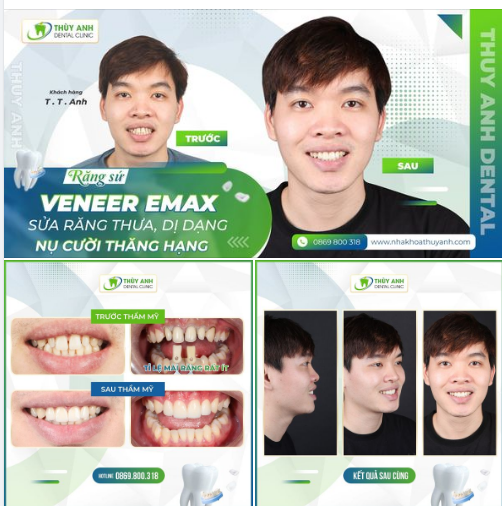 RĂNG SỨ VENEER EMAX SỬA RĂNG THƯA, DỊ DẠNG - NỤ CƯỜI THĂNG HẠNG