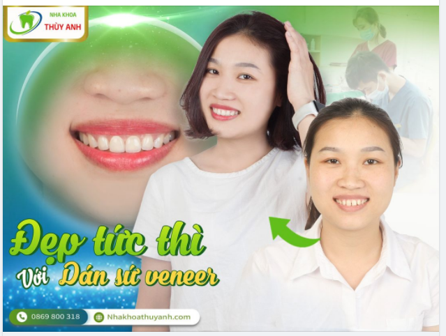 RĂNG THẨM MỸ - ĐẸP SANG NHƯ Ý