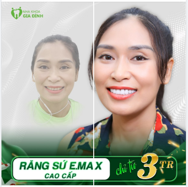 RĂNG TRƯỚC RĂNG SAU KHÁC NHAU HOÀN TOÀN 2 LẦN HẸN CÙNG BS.CKI VŨ BÍCH DIỆP SỞ HỮU NỤ CƯỜI HOÀN MỸ