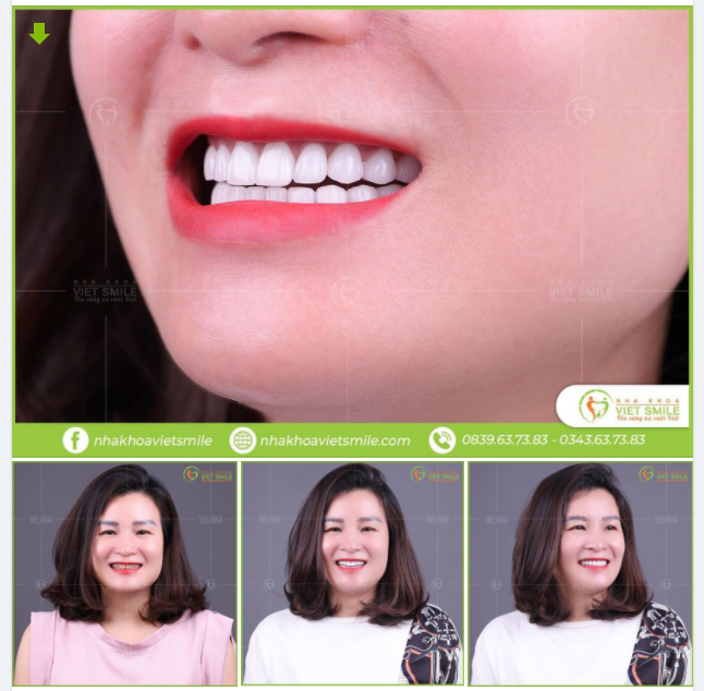 RĂNG XỈN MÀU THIẾU TỰ TIN - LÀM THẾ NÀO ĐỂ KHẮC PHỤC?