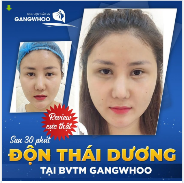 REVIEW CỰC THẬT SAU 30 PHÚT ĐỘN THÁI DƯƠNG TẠI BVTM GANGWHOO