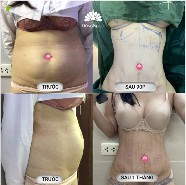 SAU 1 THÁNG HÚT MỠ TẠO HÌNH THÀNH BỤNG