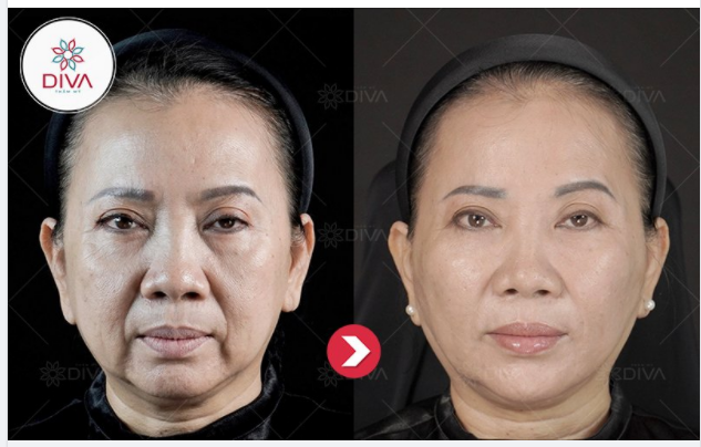 SAU 1H TIÊM 17CC FILLER MD DYNAMIC CODES – GƯƠNG MẶT CỦA DV PHƯƠNG NGỌC THAY ĐỔI RA SAO?