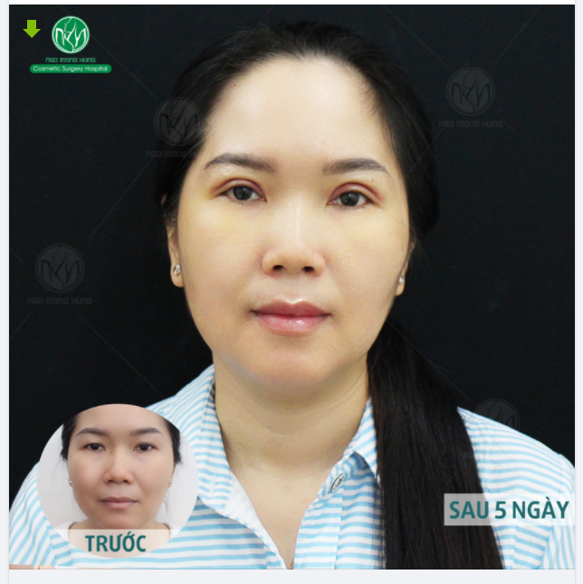 SAU 5 NGÀY CẮT MÍ - THAY ĐỔI NHƯ THẾ NÀO?