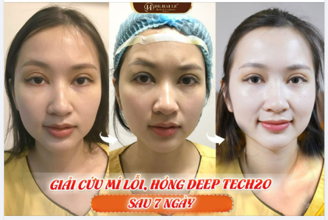 SAU 7 NGÀY SỬA MÍ DEEP TECH20 TẠI DR.HẢI LÊ TRÔNG SẼ NHƯ THẾ NÀO?