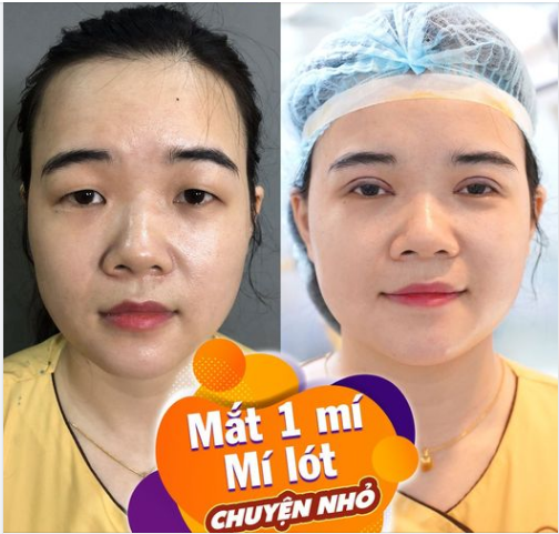 Sau cắt mí, hóa ngay girl xinh