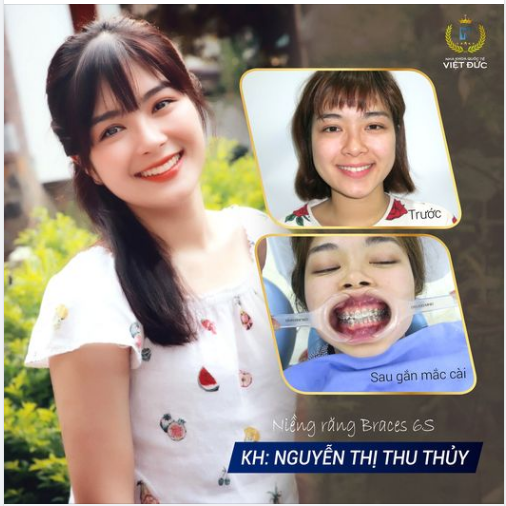 Sau hành trình 18 tháng chỉnh nha tại Nha khoa Quốc tế Việt Đức, hàm răng hô, khấp khểnh, khớp cắn lệch của Khách hàng Nguyễn Thị Thu Thủy đã hoàn toàn biến đổi, trở nên đều đẹp, khớp cắn chuẩn.