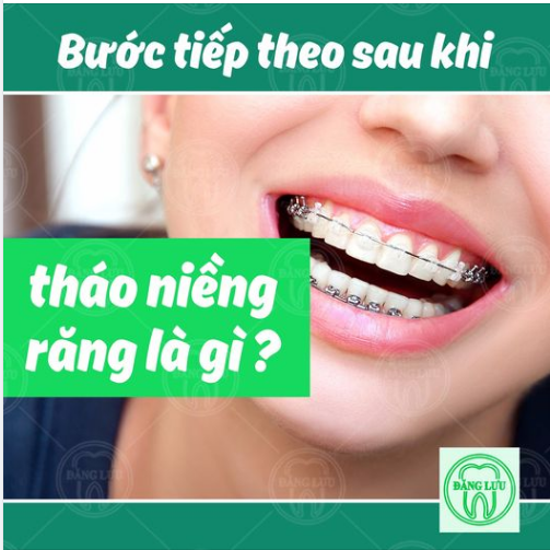Sau khi niềng răng được tháo bỏ hoàn toàn, bước tiếp theo chính là đeo HÀM DUY TRÌ. Đây là giai đoạn cuối cùng của quá trình chỉnh nha.