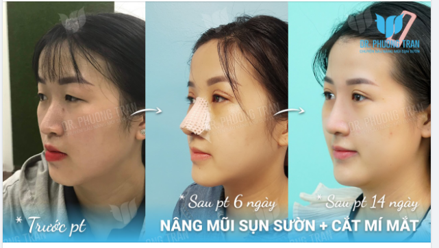 SAU NÂNG MŨI, NẰM NGHIÊNG CÓ BỊ LỆCH KHÔNG?