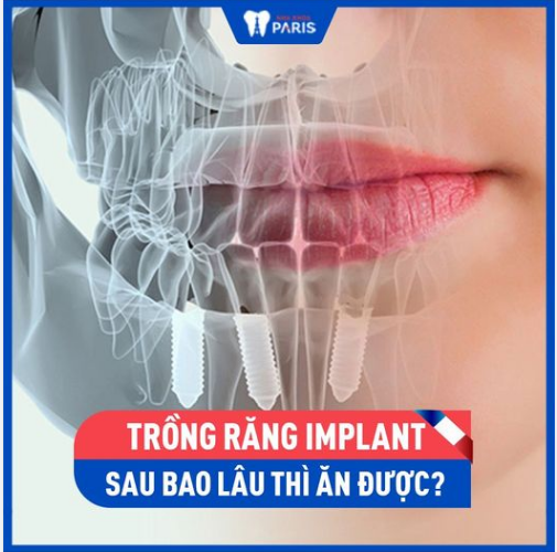 SAU TRỒNG RĂNG IMPLANT - BAO LÂU THÌ ĂN ĐƯỢC