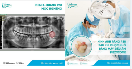 SENTOSA - NHỔ RĂNG KHÔN CHẲNG CÒN LÀ NỖI LO!