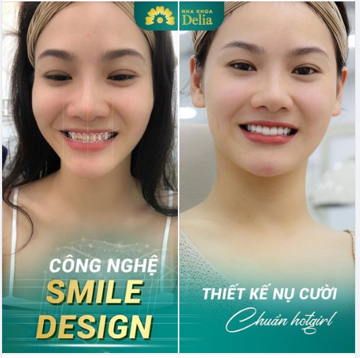 SMILE DESIGN - Kiến tạo nụ cười dành riêng cho bạn!