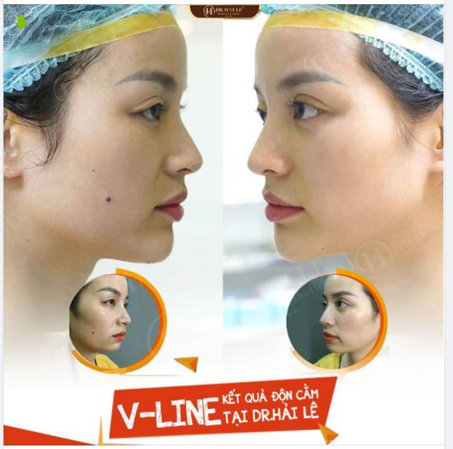 SỞ HỮU DÁNG CẰM ĐẸP VỚI ĐỘN CẰM V-LINE.!!