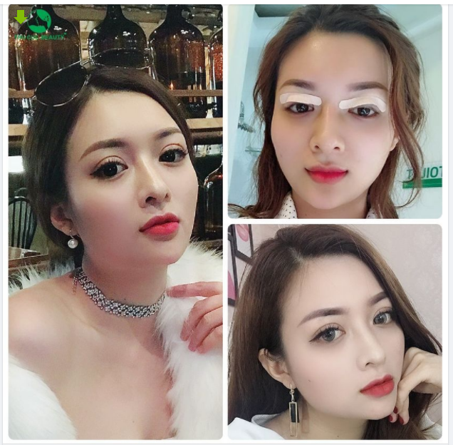 Sở hữu mí đẹp như ý 3 ngày hồi phục - 5 ngày đã sắc nét tự nhiên