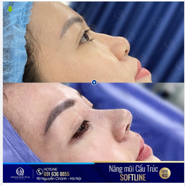 Sở hữu một chiếc mũi gồ ghề không chỉ khiến cho khuôn mặt trở nên thô kệch, kém xinh xắn mà còn không tốt về tướng số.