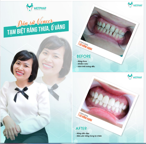 SỞ HỮU NỤ CƯỜI TỰ TIN HƠN BAO GIỜ HẾT CHỈ SAU 48H