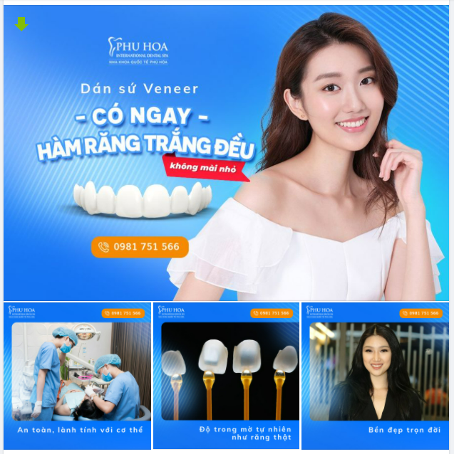 SỞ HỮU NỤ CƯỜI VẠN NGƯỜI MÊ NHỜ DÁN SỨ VENEER