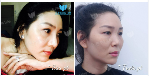SỰ KHÁC BIỆT GIỮA DIỆN MẠO HÔM QUA VÀ HÔM NAY CHÍNH LÀ ĐIỂM NHẤN Ở DÁNG MŨI!