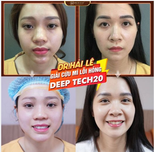 SỬA MÍ DEEP TECH20 - Đôi mắt đẹp của khách hàng là niềm vui của Dr.Hải Lê