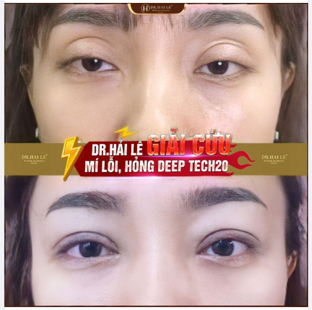 SỬA MÍ DEEP TECH20 - Đôi mắt đẹp của khách hàng là niềm vui của Dr.Hải Lê