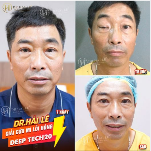 SỬA MÍ DEEP TECH20 - DR.HẢI LÊ TỰ HÀO LÀ ĐỊA CHỈ SỐ 1 SỬA MÍ LỖI, HỎNG