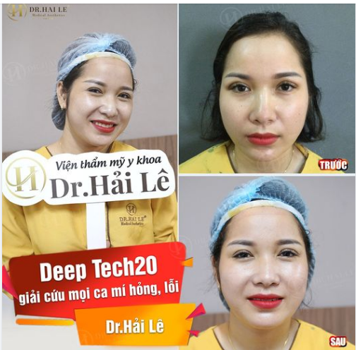  SỬA MÍ HỎNG LỖI LỰA CHỌN DR.HẢI LÊ VÌ SAO?