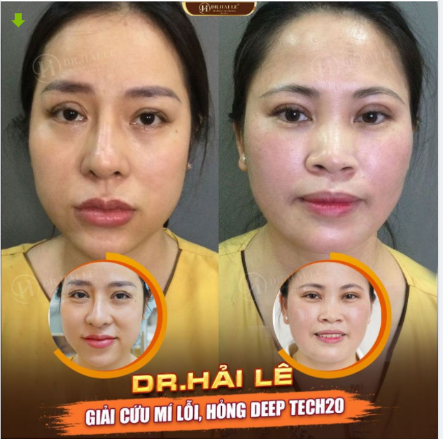SỬA MÍ “XẤU, HỎNG” DEEP TECH20 - SỬA LÀ “ĐẸP”.!!!