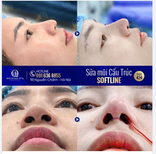 Sửa mũi cấu trúc Softline - Tạo hình dáng mũi đẹp chuẩn nhân trắc học - Thoải mái vặn vẹo, không lo lệch dáng.