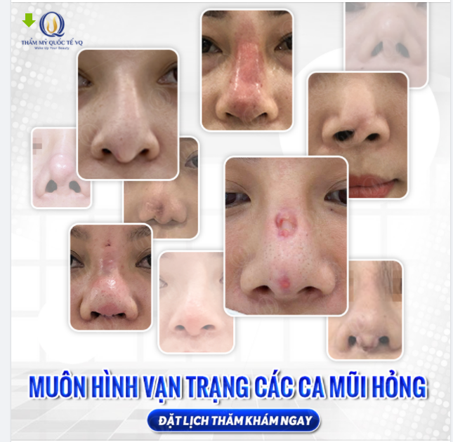 SỬA MŨI CẤU TRÚC SỤN SƯỜN NHÂN TẠO KHẮC PHỤC MỌI TÌNH TRẠNG MŨI HỎNG - GIẢI QUYẾT MỌI NỖI KHỔ CỦA KHÁCH HÀNG.