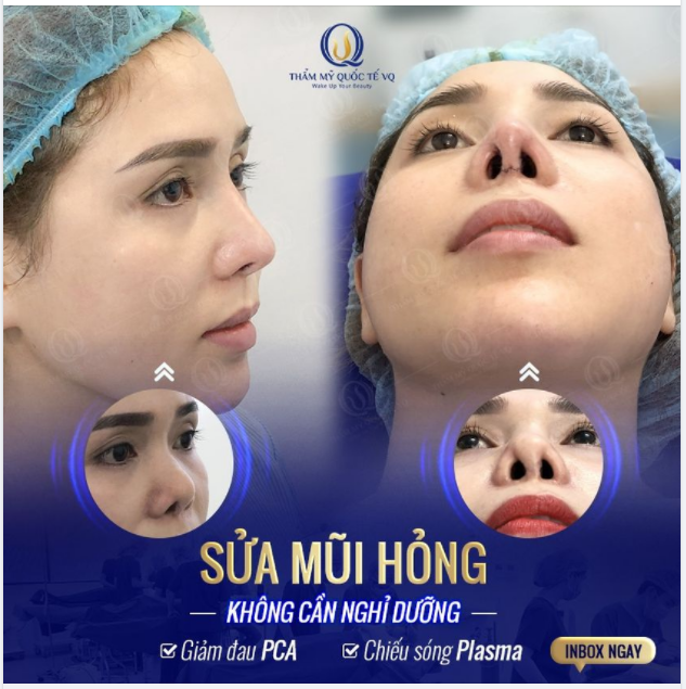 SỬA MŨI HỎNG KHÔNG ĐA.U, KHÔNG CẦN NGHỈ DƯỠNG Với GÓI GIẢM ĐAUU PCA + CHIẾU SÓNG PLASMA ULTRACELL