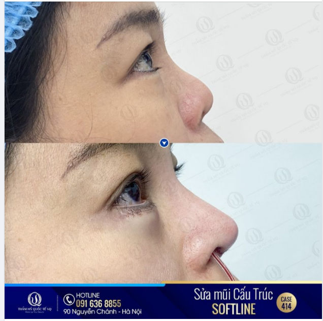 SỬA MŨI HỎNG SAU 13 NĂM THẨM MỸ