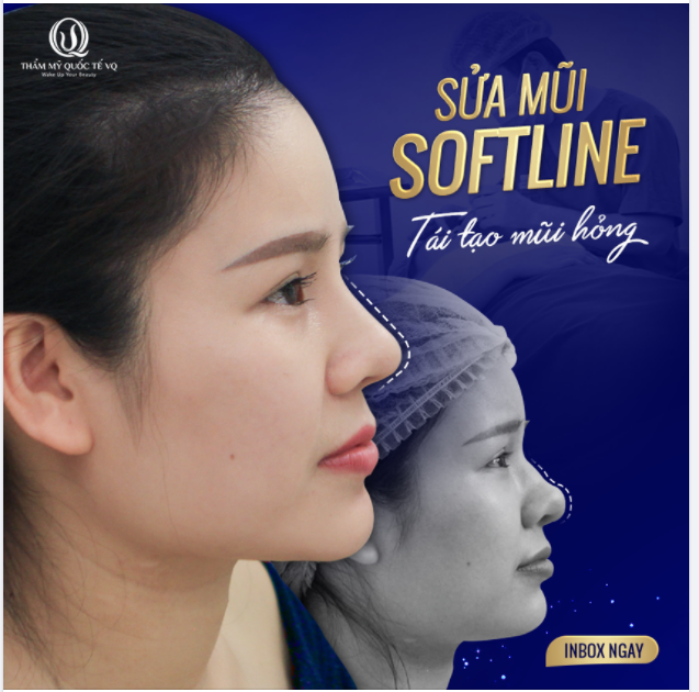 Sửa mũi Softline - Tái tạo mũi hỏng