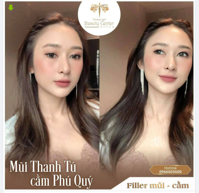 Sức mạnh của Filler Mũi -Cằm