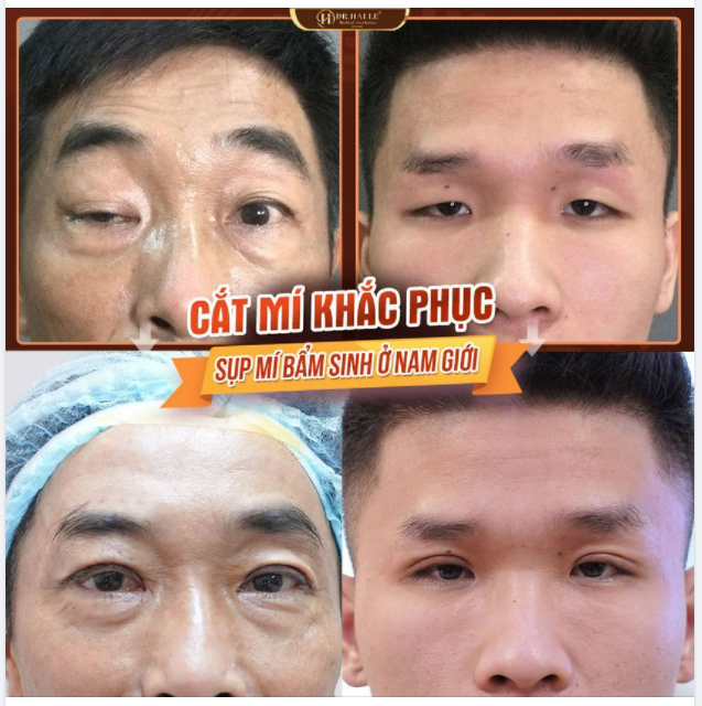 Sụp mí bẩm sinh có chữa được không?