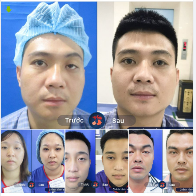 SỤP MÍ BẤM SINH, mắt lờ đờ và kết quả sau Chỉnh Hình