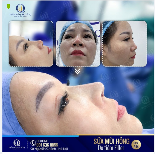 TÁI CẤU TRÚC – KHẮC PHỤC MŨI TRÀN FILLER