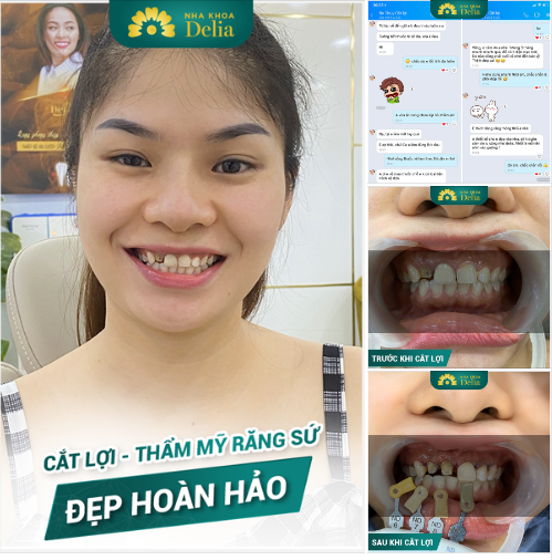 TẠI SAO DELIA KHÔNG PHỤC HÌNH RĂNG SỨ NGAY CHO CHỊ THUỲ?