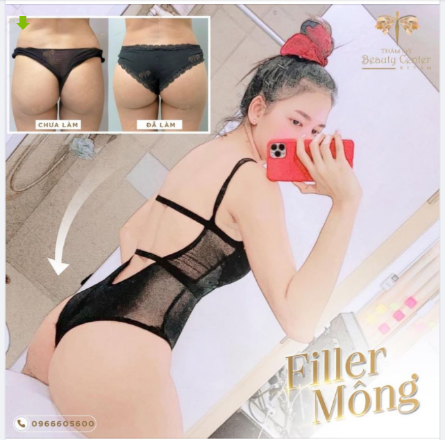 Tại sao lại chọn FILLER MÔNG tại Thẩm mỹ Beauty Center by Tấm: