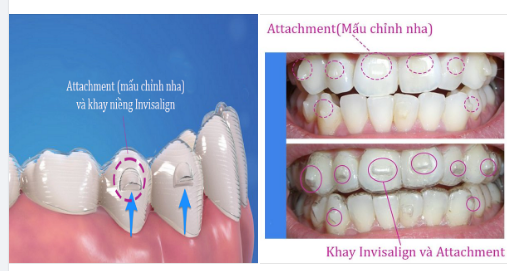 Tại sao một số khay chỉnh nha của tôi lại có các chỗ lồi hoặc gờ trên đó?