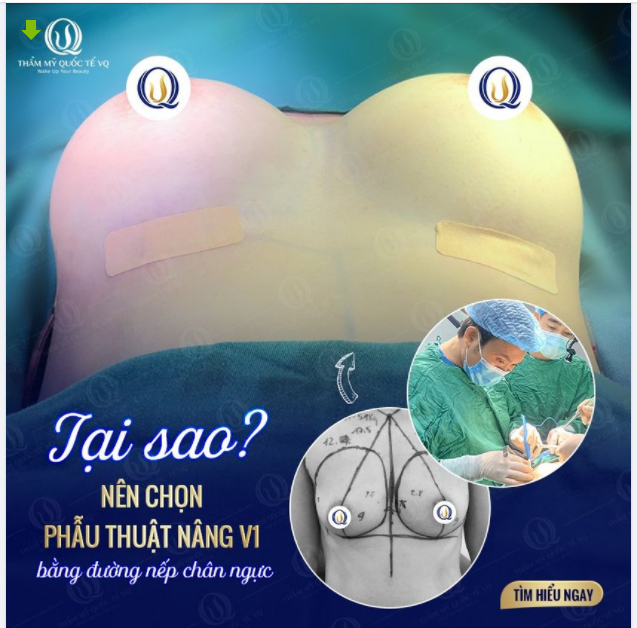 TẠI SAO NÊN CHỌN PHẪU THUẬT NÂNG V1 BẰNG ĐƯỜNG NẾP CHÂN NGỰCC.