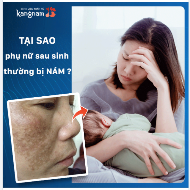 Tại sao phụ nữ sau sinh thường bị NÁM?