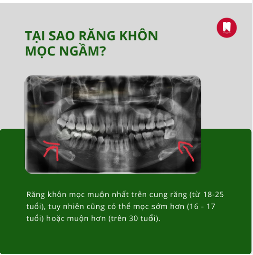 TẠI SAO RĂNG KHÔN MỌC NGẦM