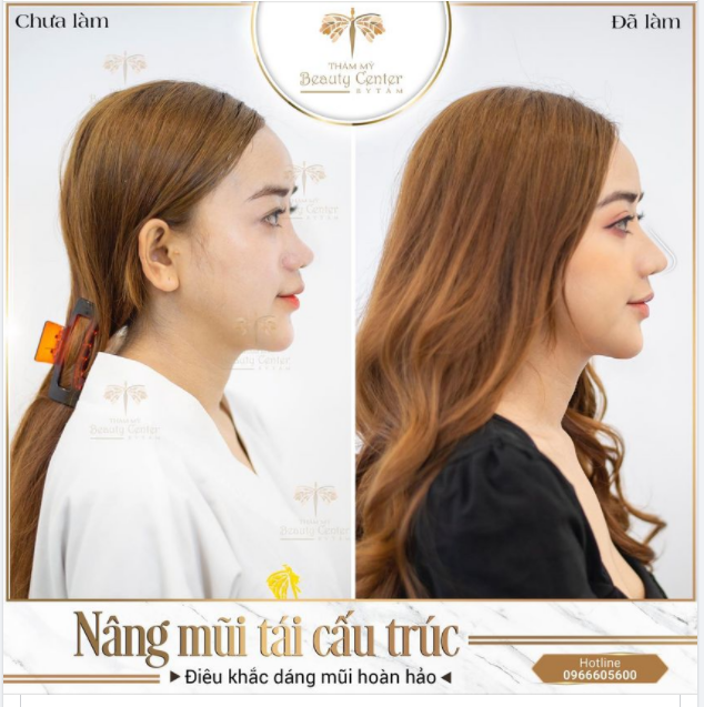 TẠM BIỆT MỌI KHUYẾT ĐIỂM VỀ MŨI NHỜ NÂNG MŨI TÁI CẤU TRÚC