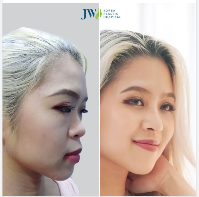 TẠM BIỆT MŨI TẸT - LÊN NGÔI MŨI ĐẸP