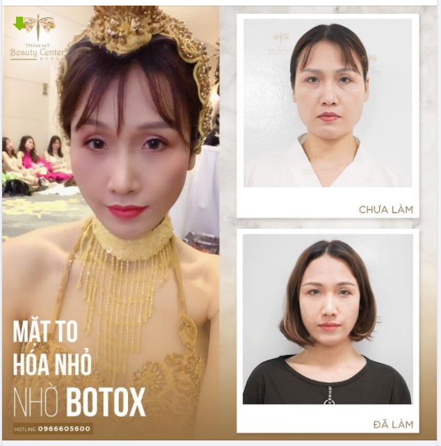 Tạm biệt ngay các app chụp ảnh bóp mặt khi khách hàng dễ dàng sở hữu mặt Vline sau 15 phút với Botox tại Thẩm mỹ Beauty Center by Tấm