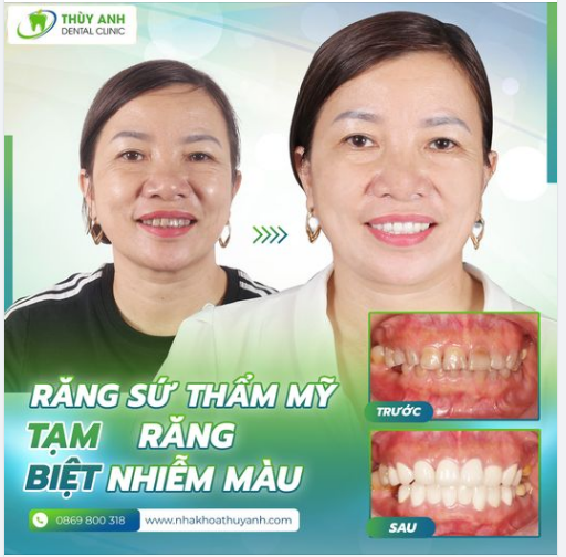 TẠM BIỆT RĂNG NHIỄM MÀU - KIẾN TẠO NỤ CƯỜI TRẮNG SÁNG TỰ NHIÊN