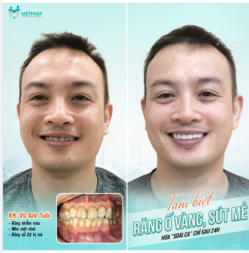 TẠM BIỆT RĂNG Ố VÀNG, SỨT MẺ CHỈ SAU 24H